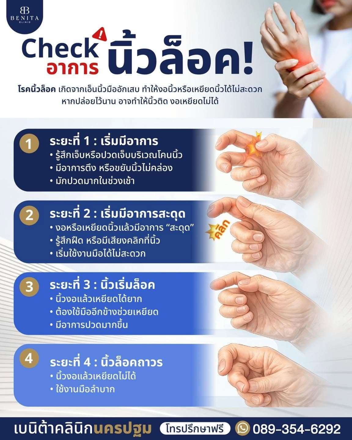 ภาพประกอบนิ้วล็อก