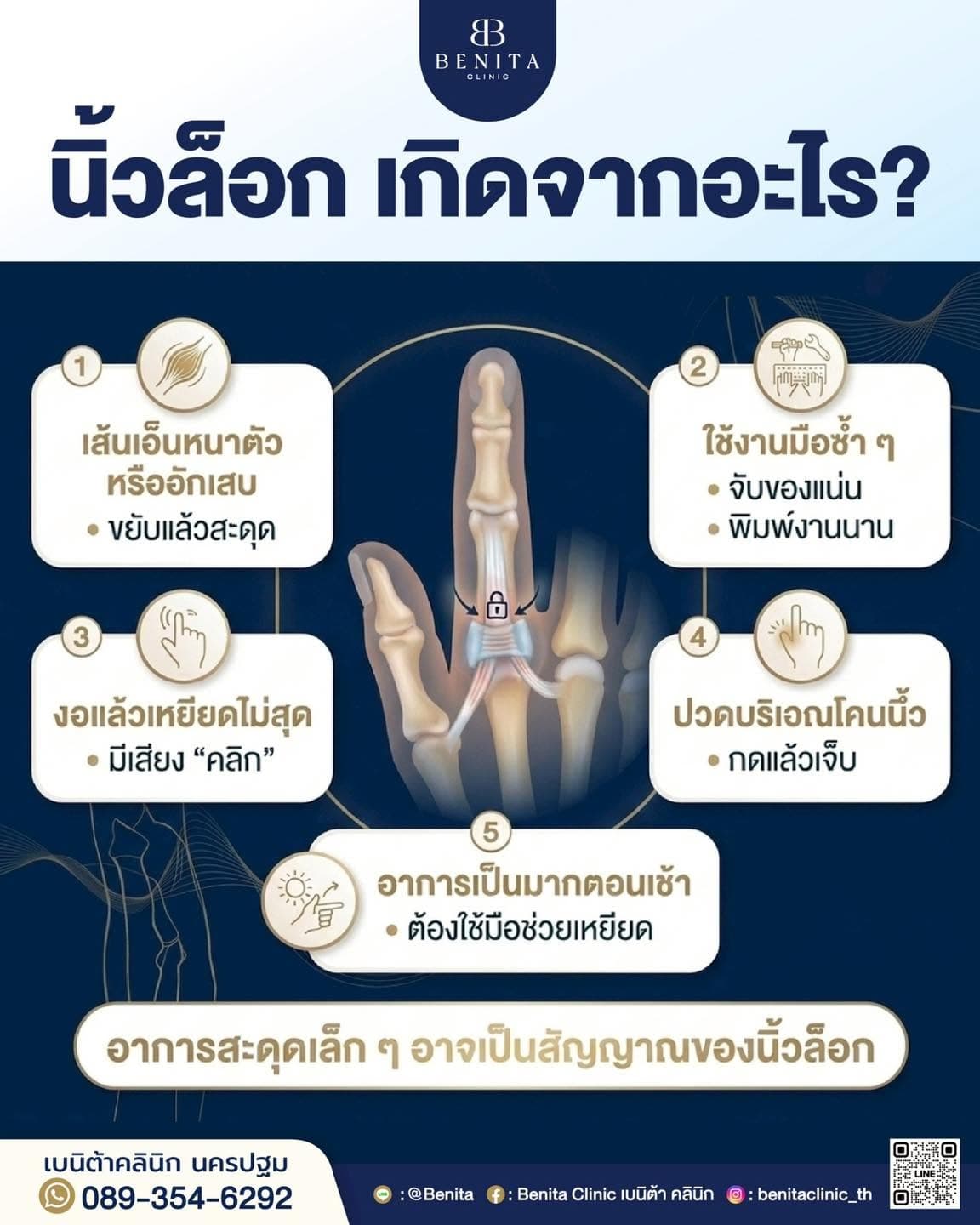 ภาพประกอบนิ้วล็อก