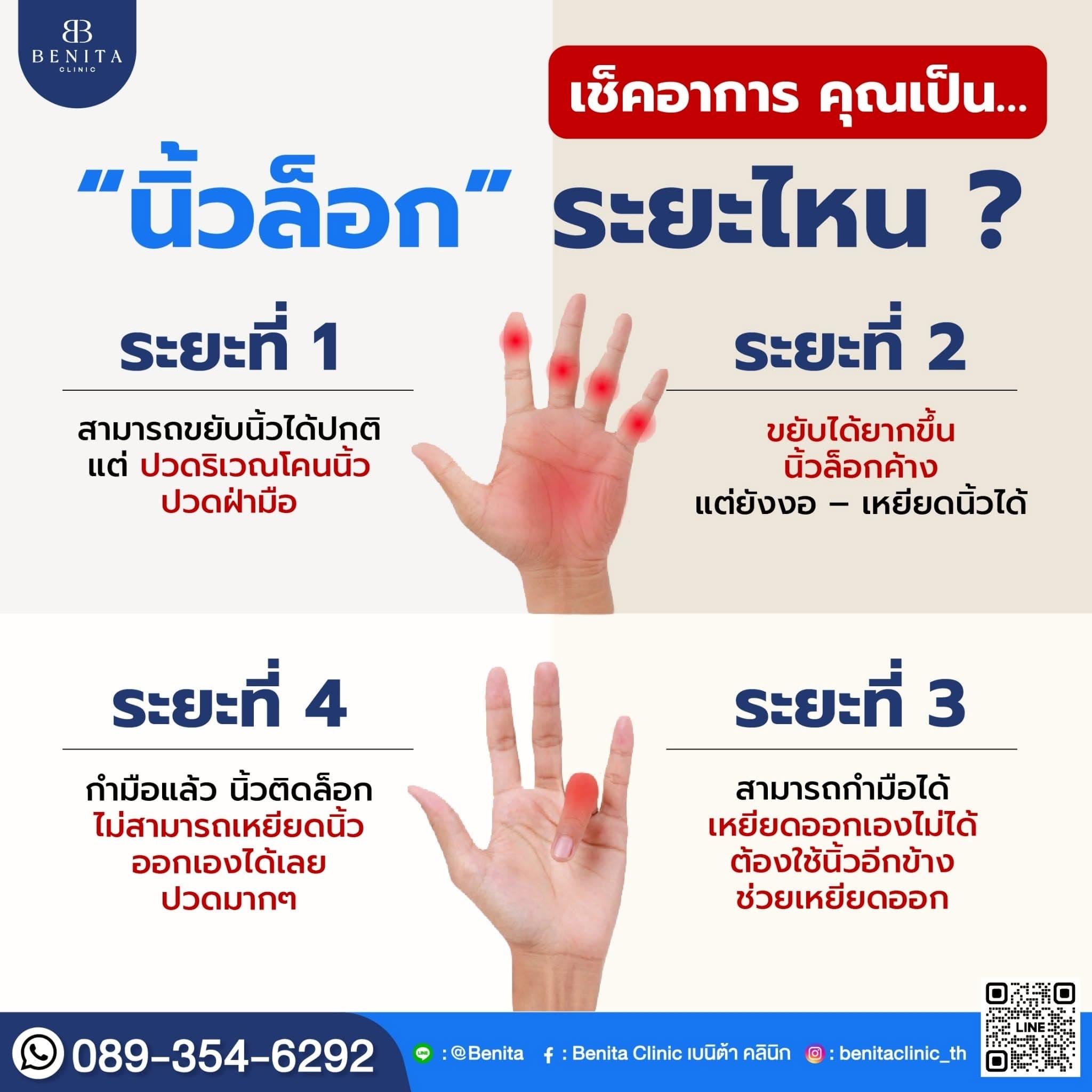 ภาพประกอบนิ้วล็อก